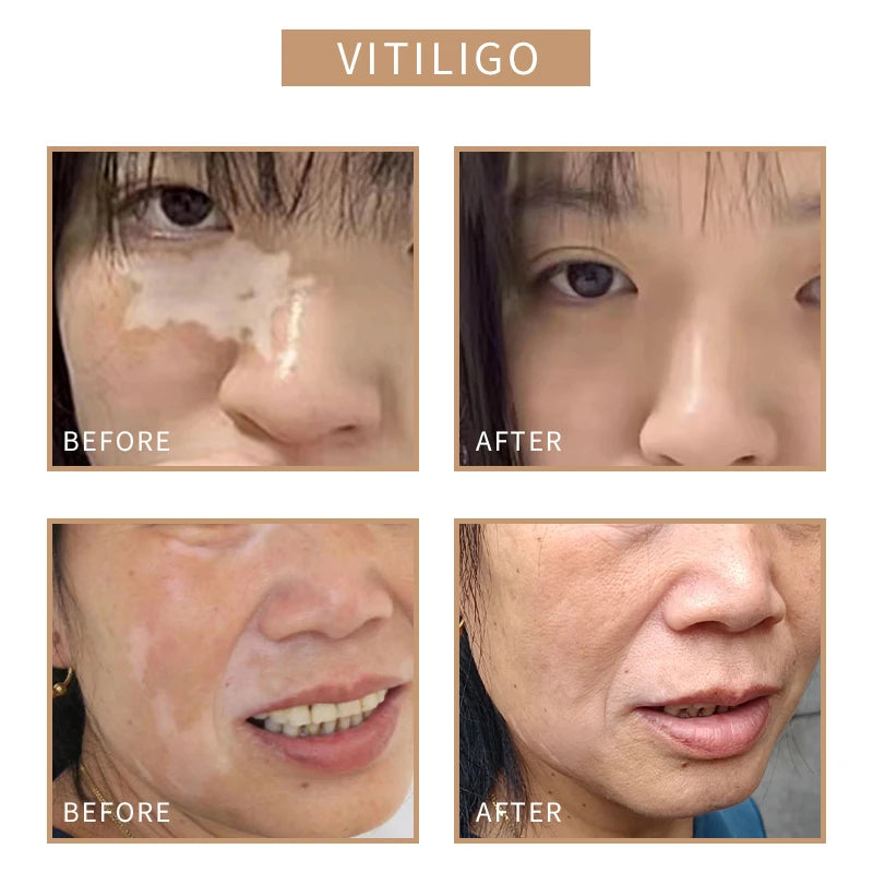 Skin Tone Stretch Mark Face Paint Scar Camouflage Tattoo Ink Scar Removal Pigmentation